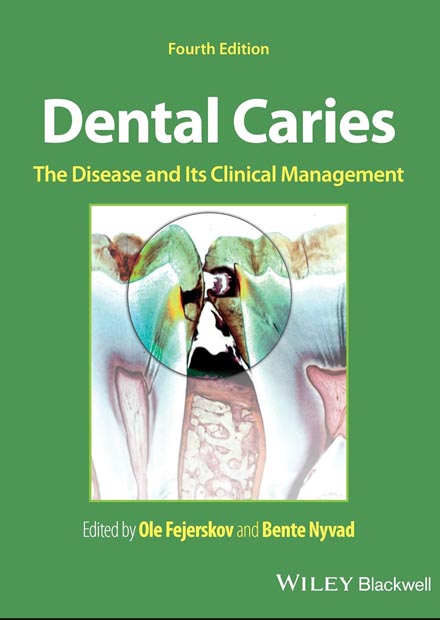 Dental Caries: The Disease and its Clinical Management